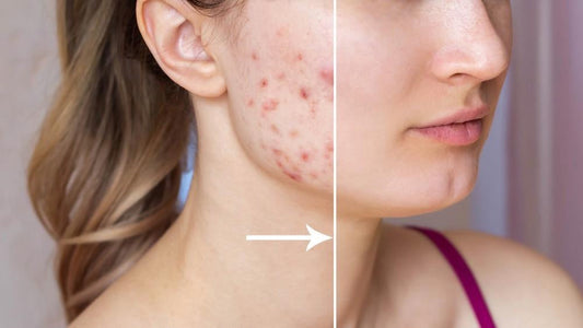 Microneedling for Acne Scars: Benefits and Risks