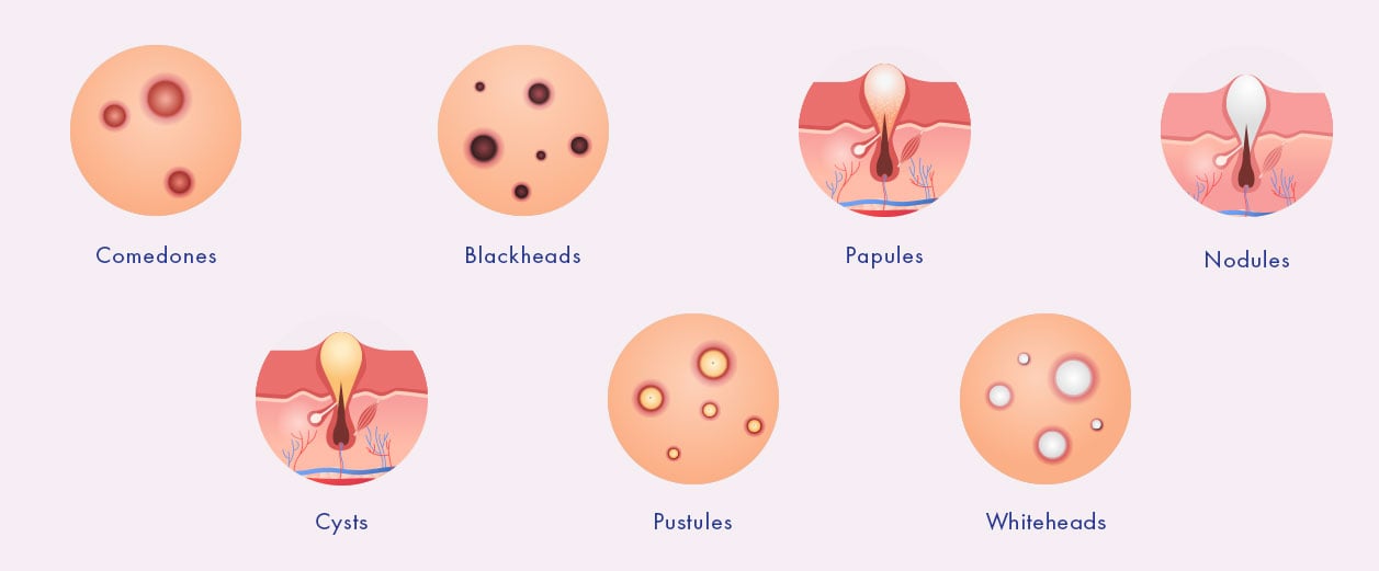 Understanding Different Types of Acne: From Whiteheads to Cysts ...