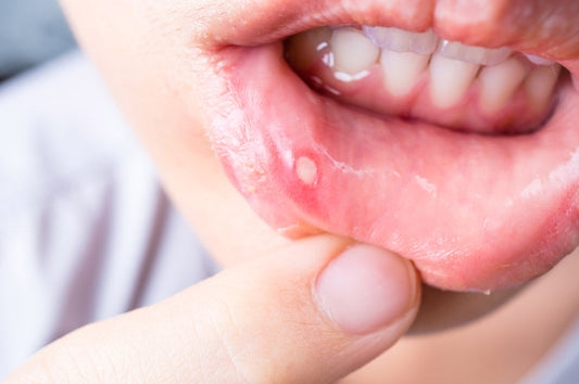 Canker Sores: Causes, Treatment, and Prevention