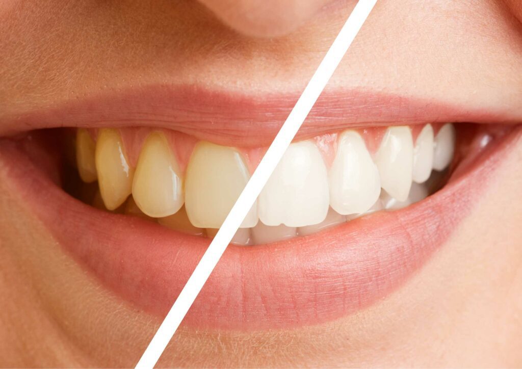 Whitening Toothpastes: Do They Really Whiten Teeth?