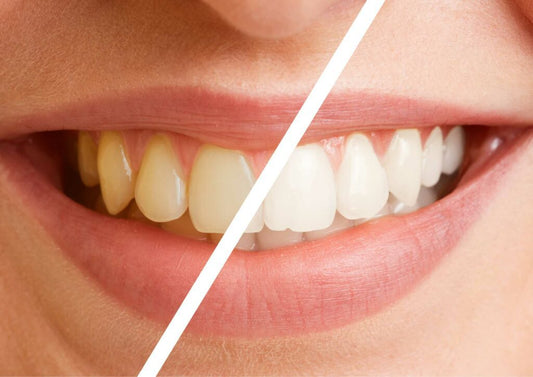 Whitening Toothpastes: Do They Really Whiten Teeth?