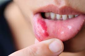 Understanding Oral Thrush: Symptoms and Treatments