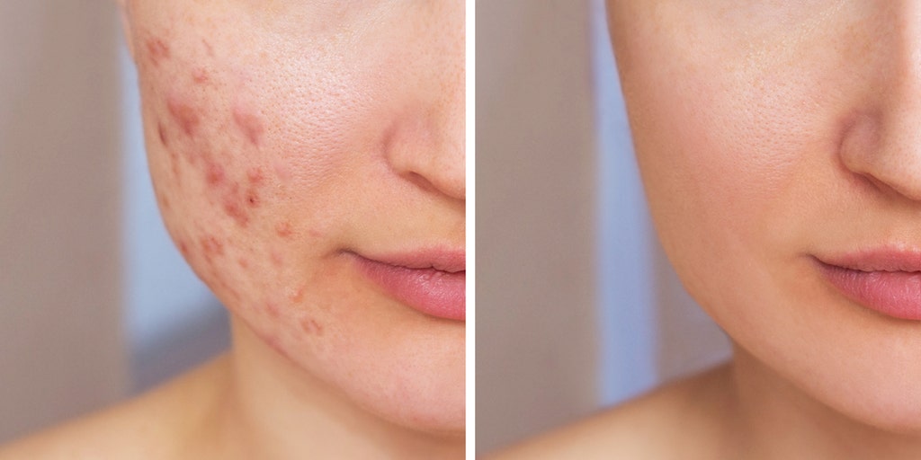 Managing Adult Acne: Causes and Treatments