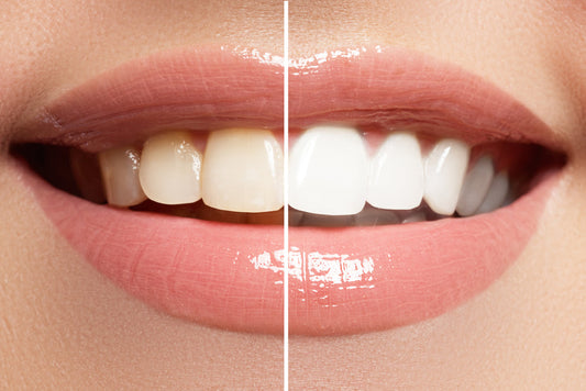 Whitening for Special Occasions: Timing Your Treatment