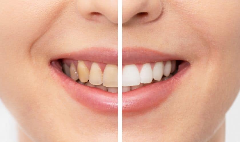 Best Whitening Toothpastes Reviewed: Do They Make a Difference?