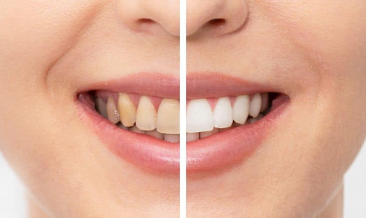 Best Whitening Toothpastes Reviewed: Do They Make a Difference?