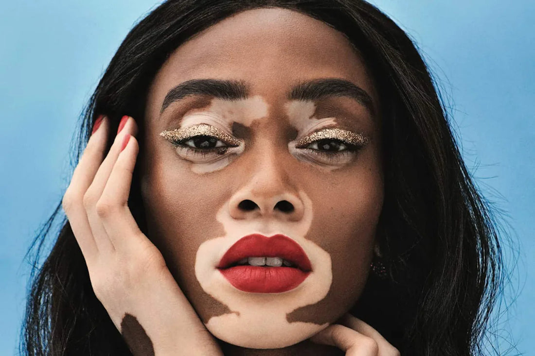 Winnie Harlow