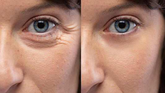 Understanding Fine Lines vs. Wrinkles: Treatment Options