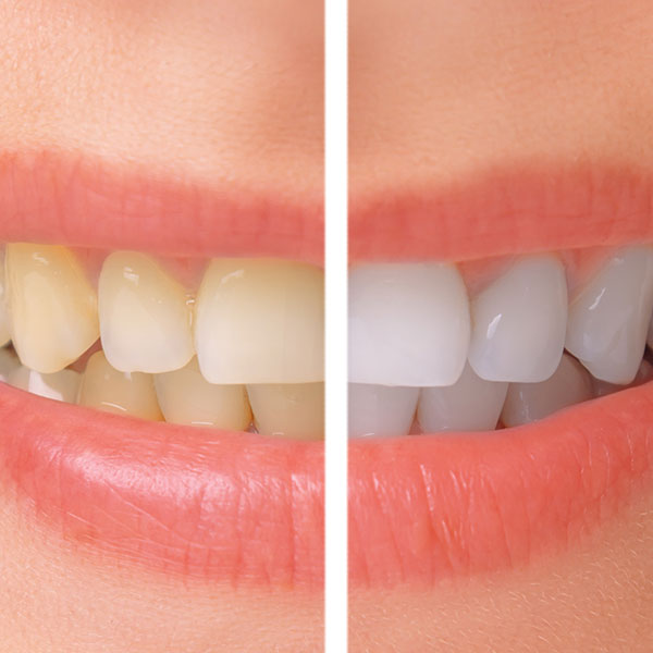 Gum Contouring: Reshaping Your Gums for a Better Smile